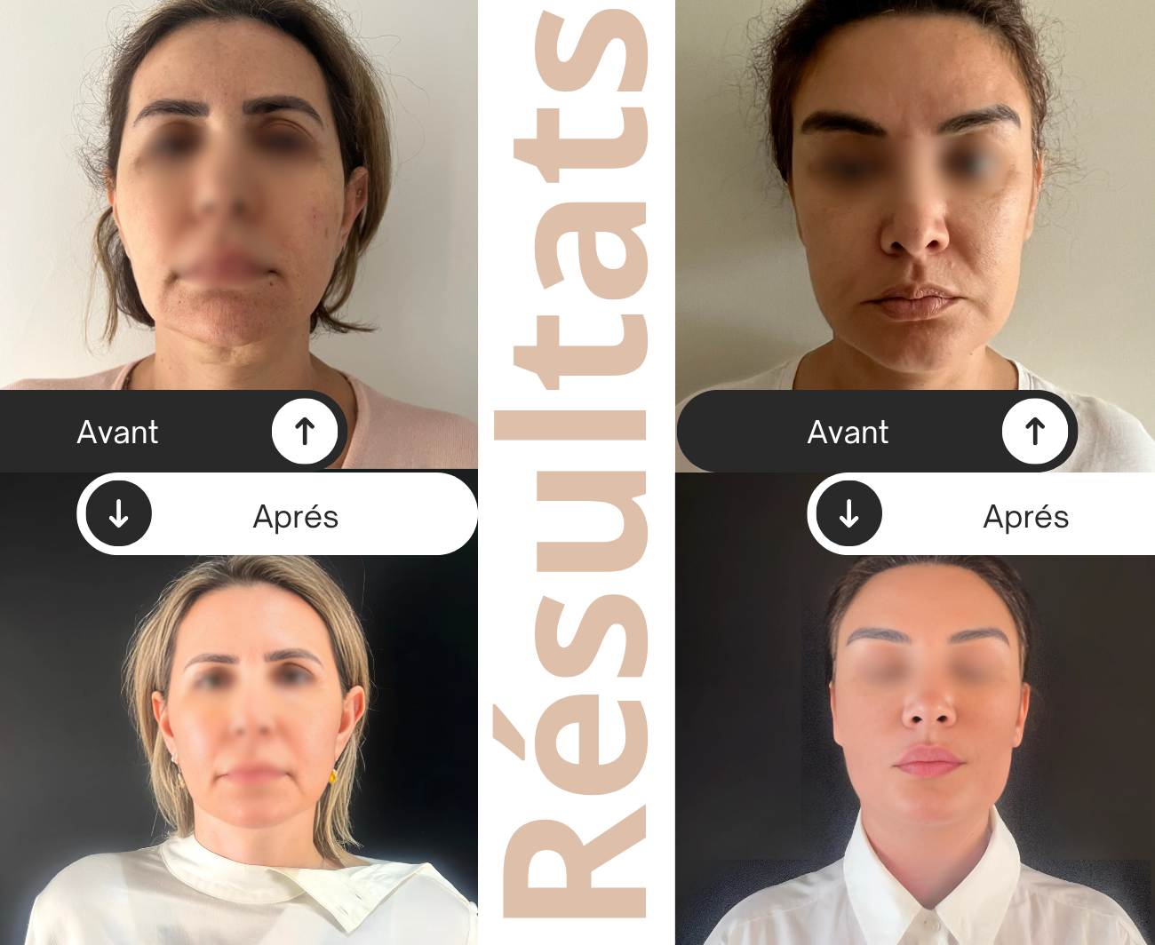 Lifting cervico-facial – Raffermir et rajeunir naturellement