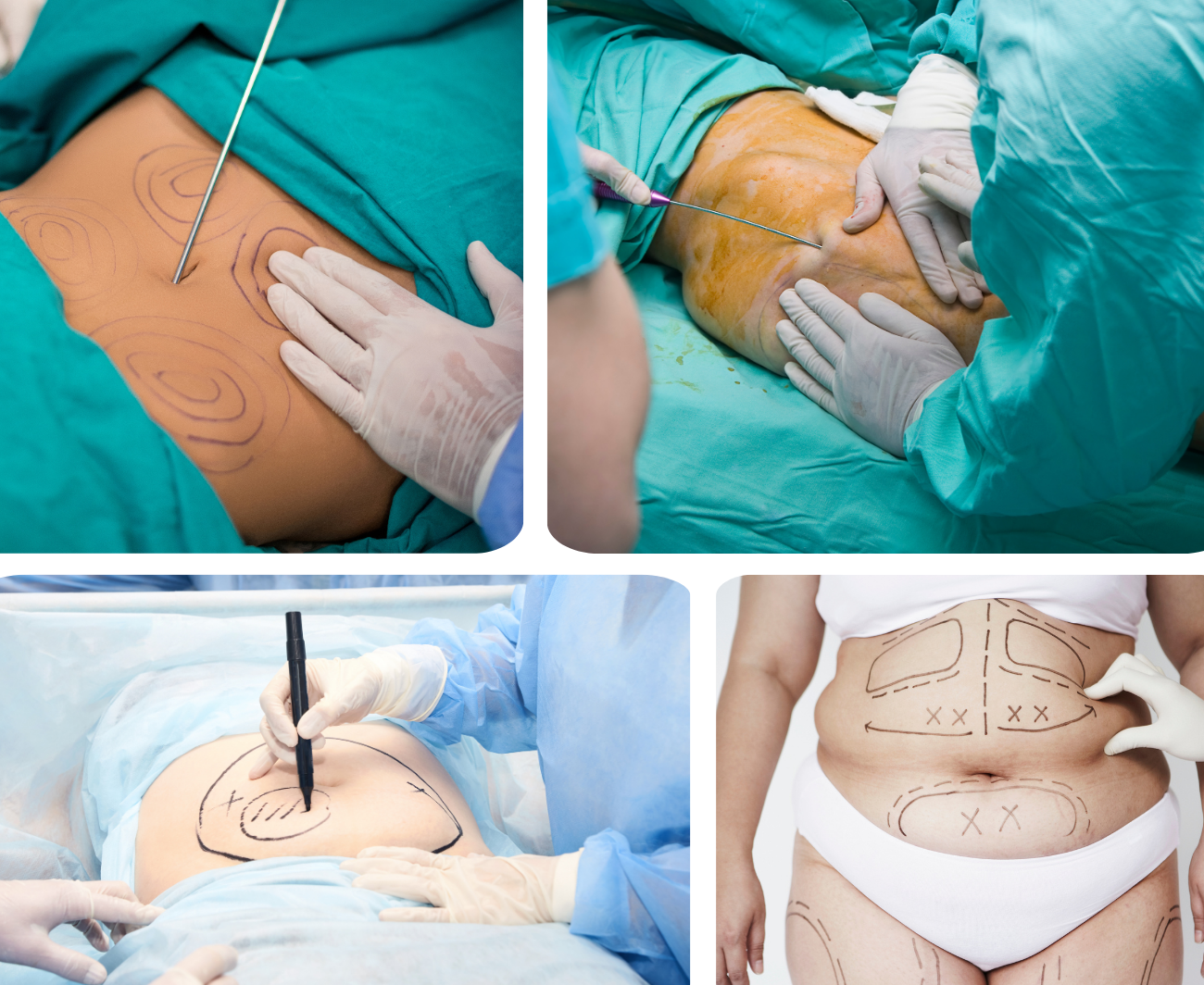 Liposculture à Casablanca – Dr Chabbak