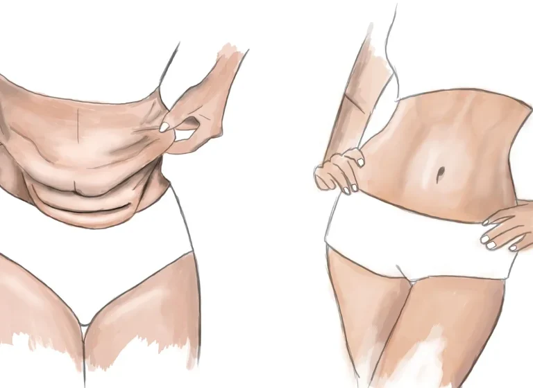 dr chabbak hakim Abdominoplastie