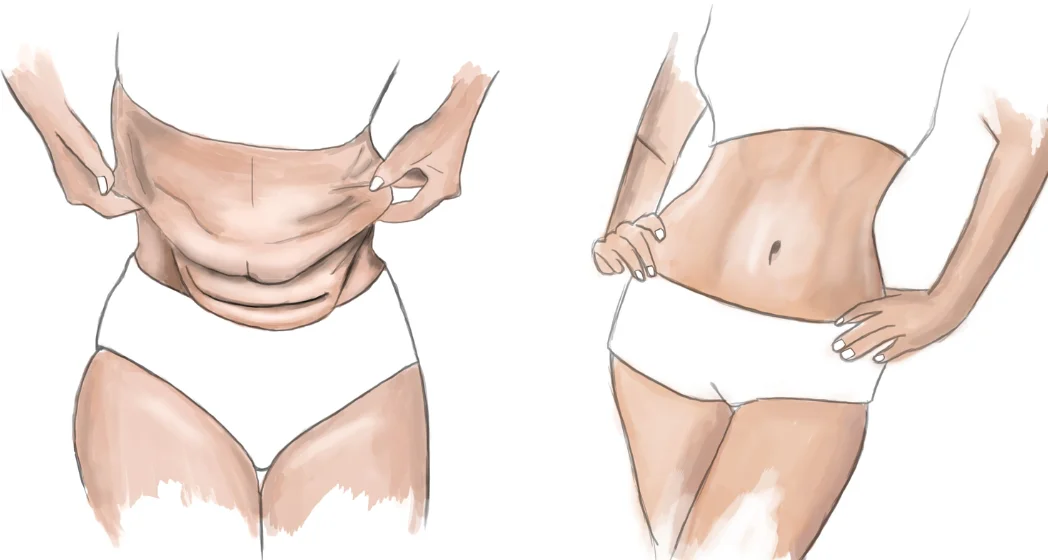 dr chabbak hakim Abdominoplastie