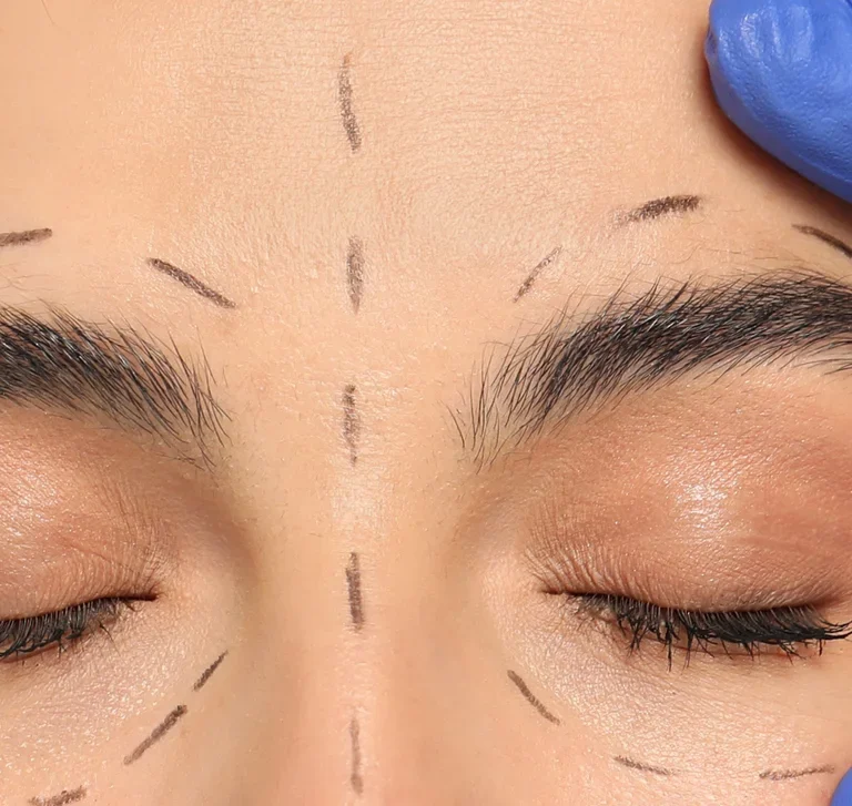 dr chabbak-hakim portfolio-Blépharoplastie