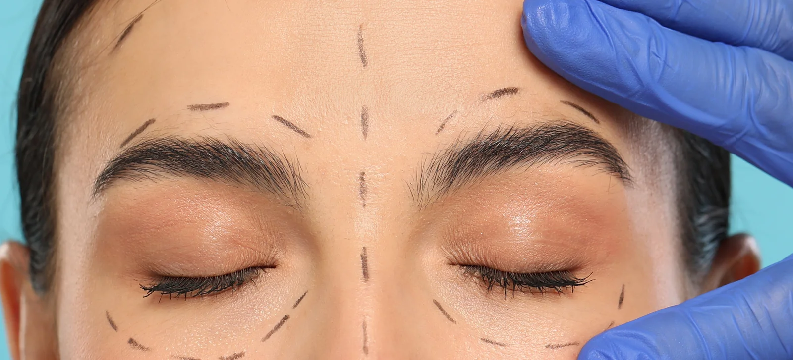 dr chabbak-hakim portfolio-Blépharoplastie