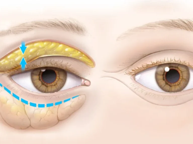 dr chabbak-hakim portfolio-Blépharoplastie