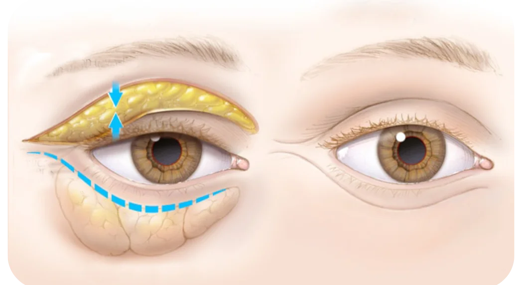 dr chabbak-hakim portfolio-Blépharoplastie