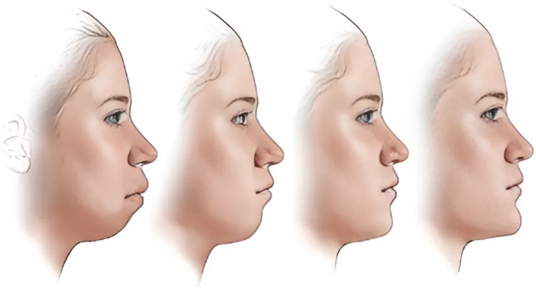 Liposuccion du menton : la solution efficace contre le double menton