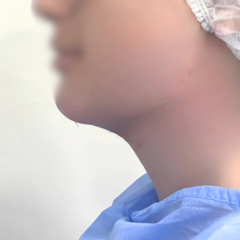 hcaesthetics- avant apres -double menton apres