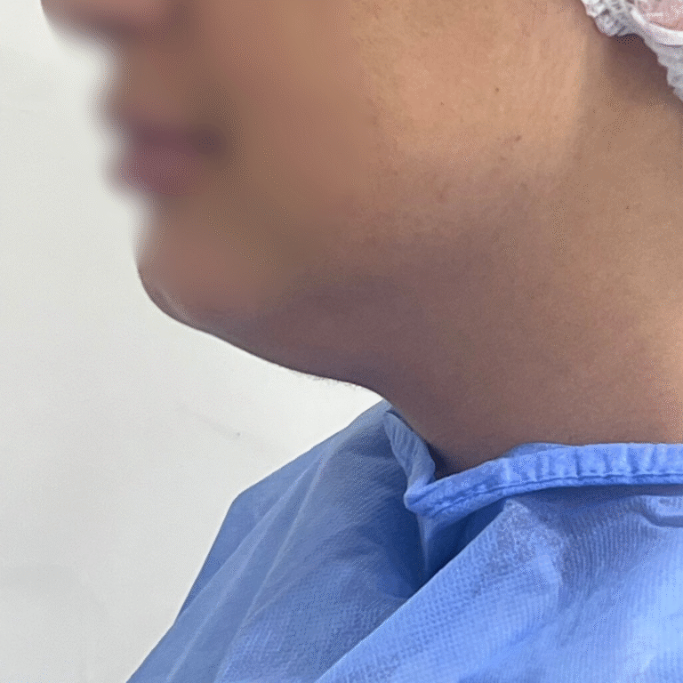 hcaesthetics- avant apres -double menton avant