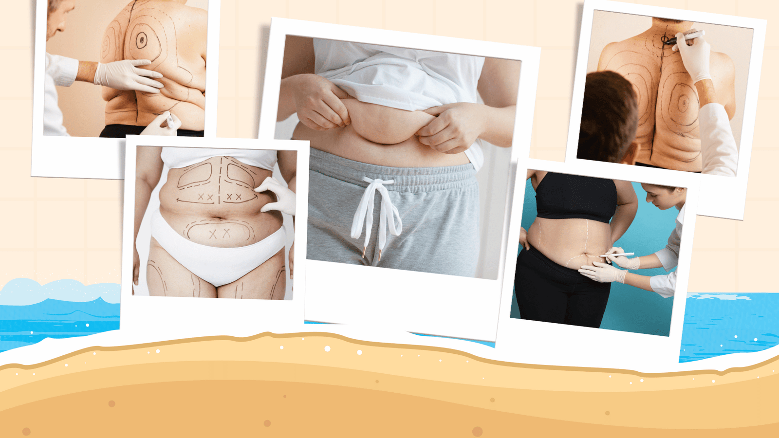 Liposuccion en été à Casablanca – Dr Chabbak Hakim | HC Aesthetics