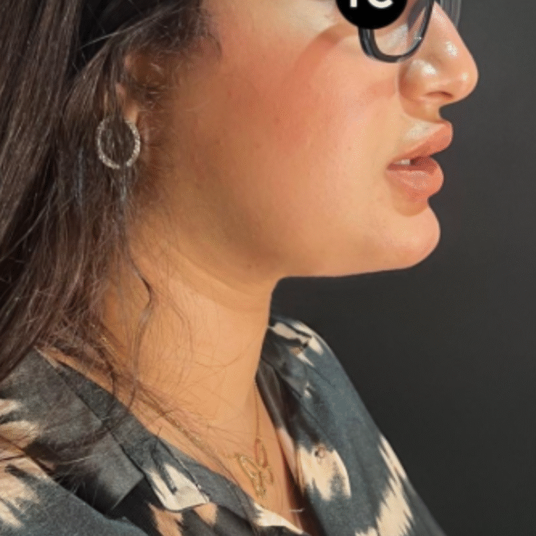 Liposuccion du menton à Casablanca : la solution efficace contre le double menton​