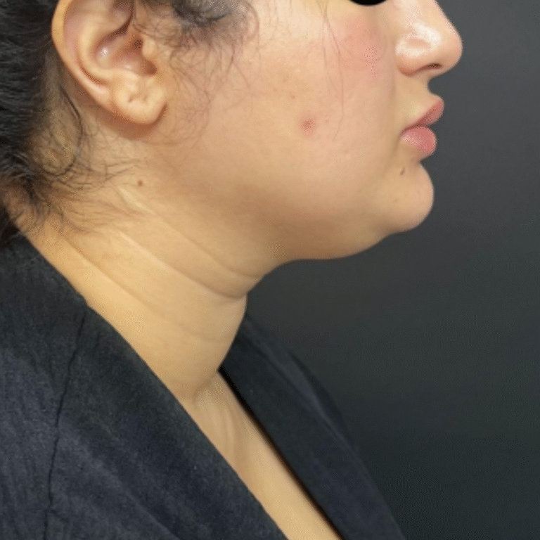 Liposuccion du menton à Casablanca : la solution efficace contre le double menton​