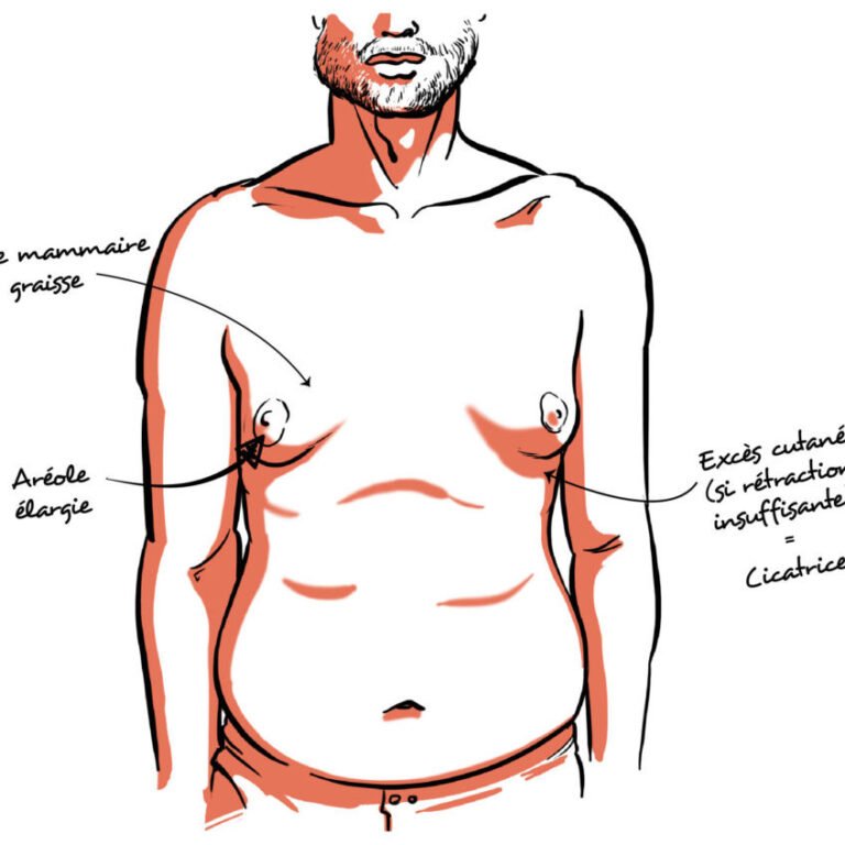 Chirurgie de la gynécomastie : une intervention simple pour un changement majeur