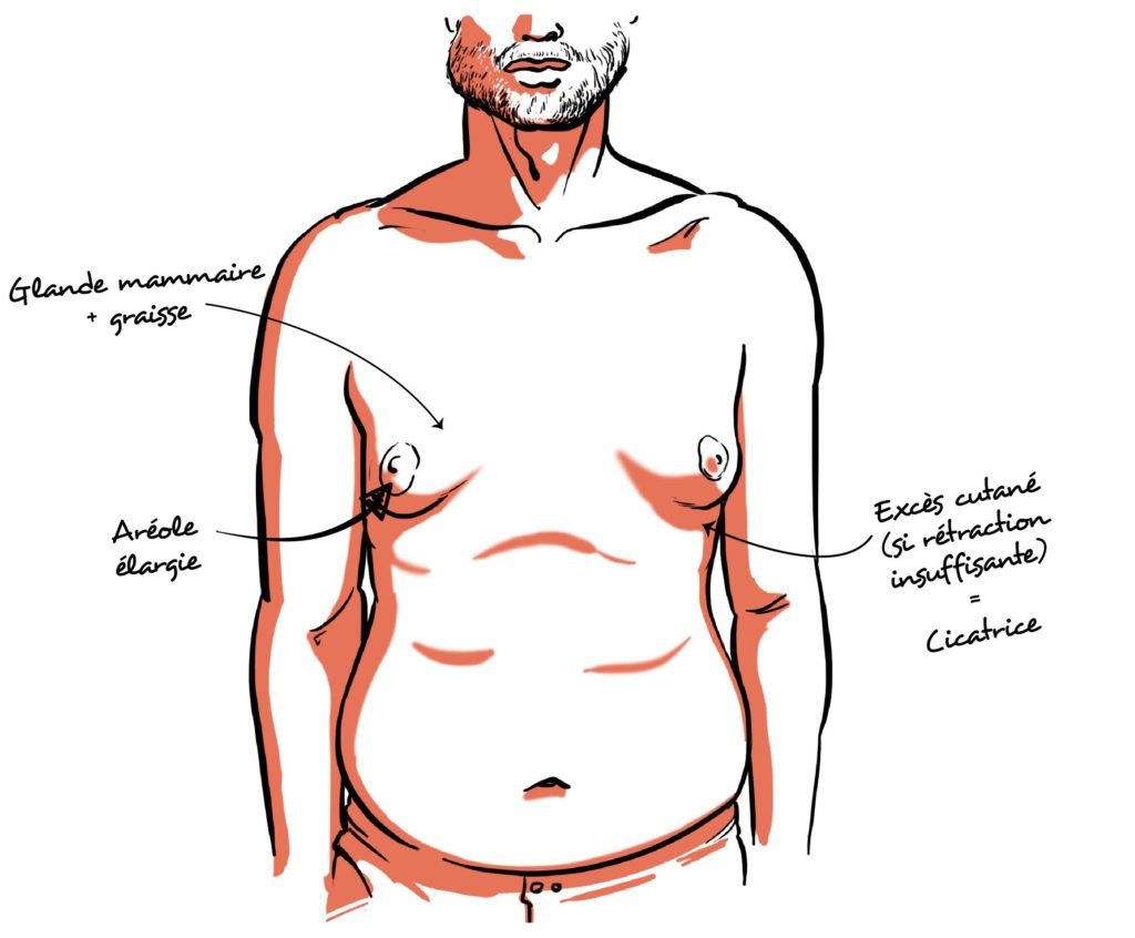 Chirurgie de la gynécomastie : une intervention simple pour un changement majeur