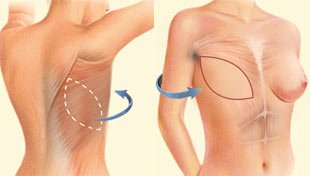 La reconstruction par lambeau (2)