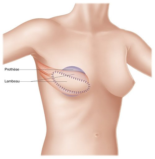 Reconstruction combinée (lambeau + implant) (1)