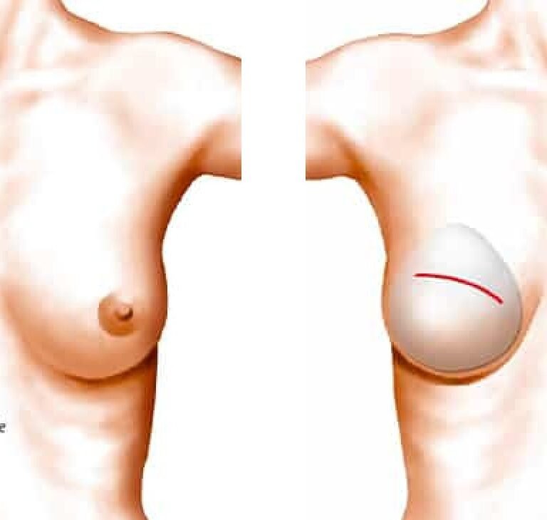 la reconstruction mammaire par prothèse