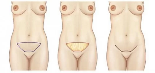 Mini-abdominoplastie : la solution parfaite pour un petit relâchement du bas-ventre​