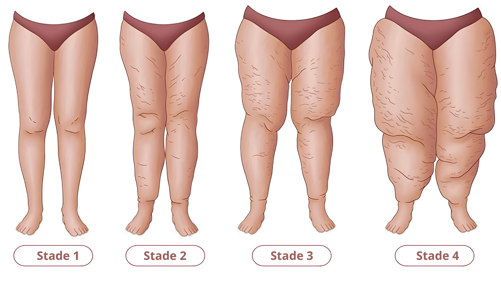 Lipœdème : Pourquoi vos Jambes Grossissent Malgré le Régime et le Sport