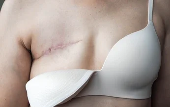 Réduction Mammaire après un Cancer du Sein : dans Quels Cas est-elle Envisageable ?