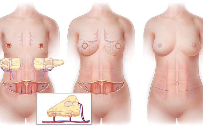 Après un Cancer du Sein : Comment Retrouver une Harmonie entre les Deux Seins ?