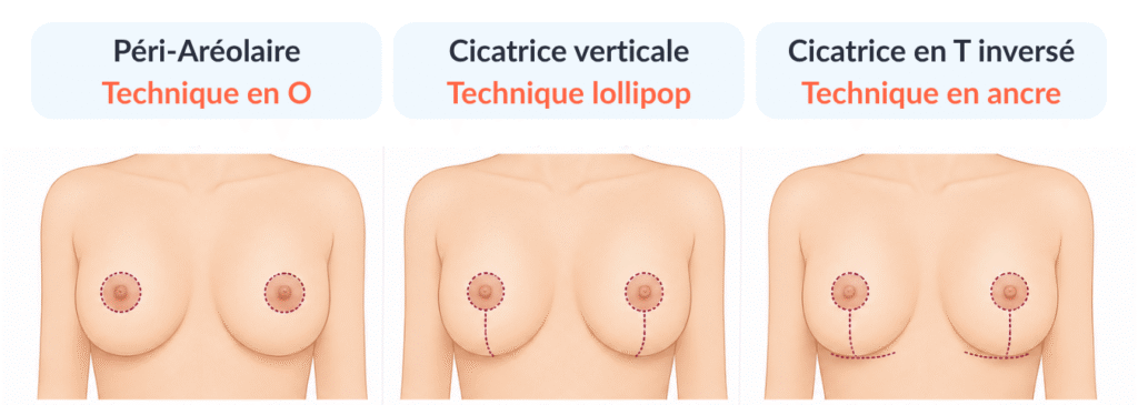 Cicatrisation après réduction mammaire
