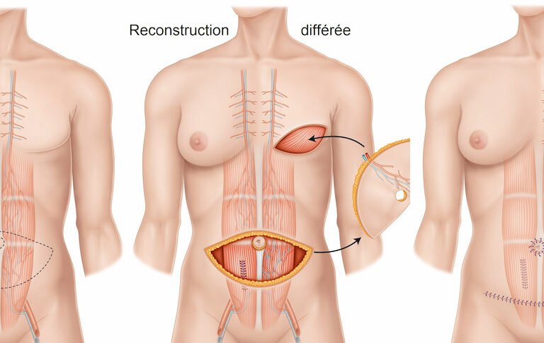 Reconstruction mammaire après mastectomie : quelles options sont possibles ?