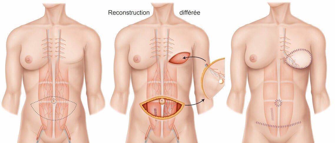 Reconstruction mammaire après mastectomie : quelles options sont possibles ?
